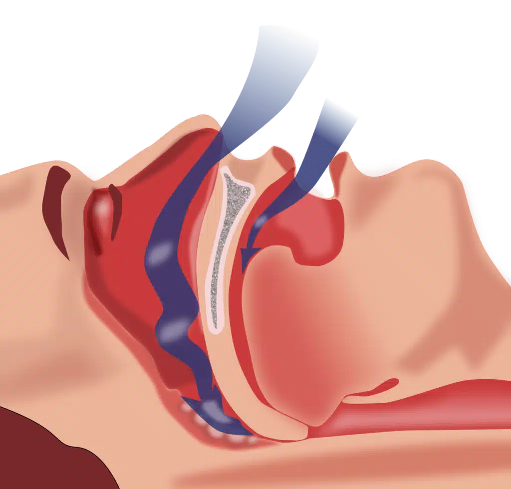 Snoring & Sleep Apnea Treatment Mississauga