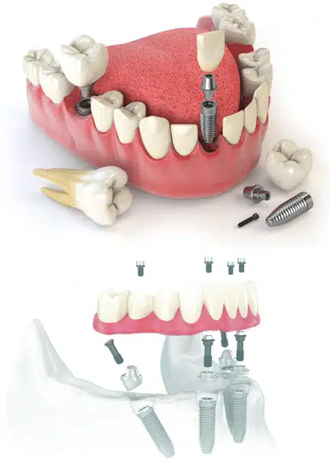 all on 4 dental implants Mississauga