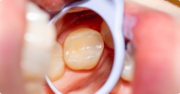 Dental Fillings in Mississauga, ON